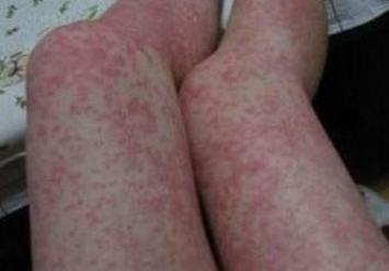 患了皮肤过敏疾病什么食品是不可以吃的