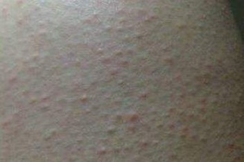 季节对皮肤瘙痒有哪些影响