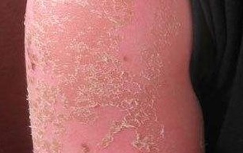 季节性皮肤瘙痒症是如何导致的