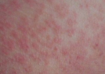 老年性皮肤瘙痒症可以治吗