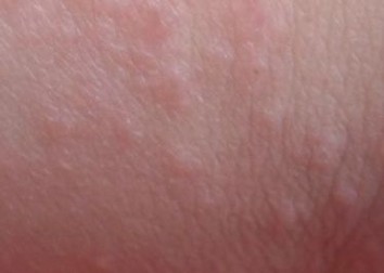 皮肤干燥瘙痒是什么原因