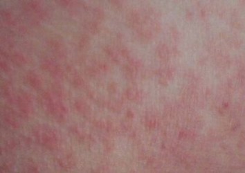 皮肤红肿瘙痒的病因有什么