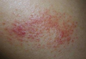 导致皮肤瘙痒的有哪些原因