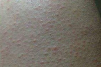 导致皮肤瘙痒发病有什么原因