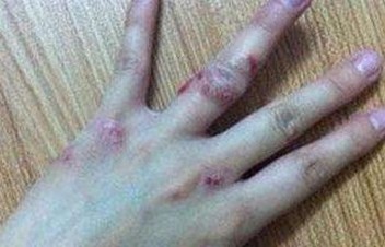 改善皮肤瘙痒有哪些预防措施