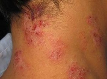青岛常见脂溢性皮炎的治疗的手法