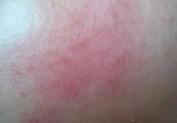 青岛传统疗法治疗皮炎的弊端是什么