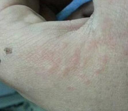 疥疮有哪些相对比较明显症状