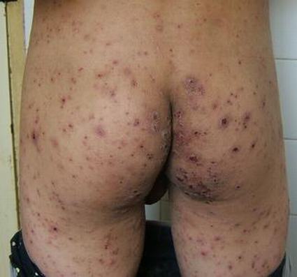 妇女疥疮的临床症状