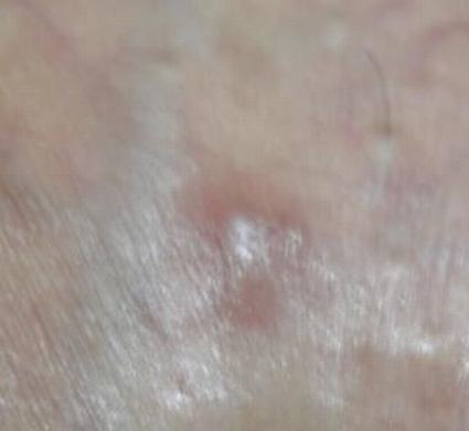 患有疥疮要赶紧治疗