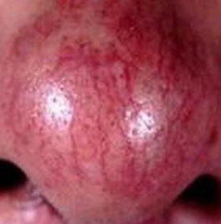 酒渣鼻的护理是要注意哪些