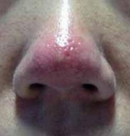 酒渣鼻的致病因素都有什么呢