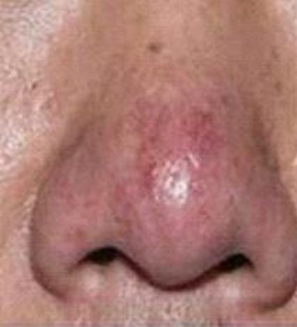 酒渣鼻可以分为哪几种类型呢