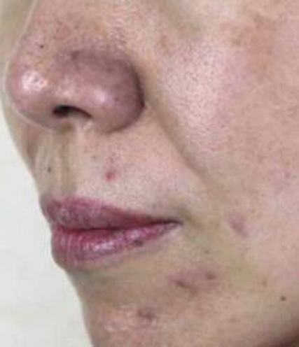 酒渣鼻怎样治疗