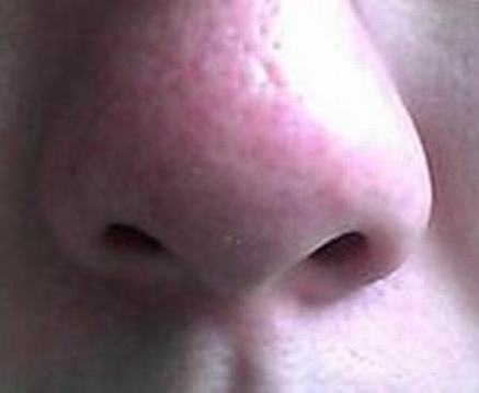 引起酒糟鼻的病因是什么