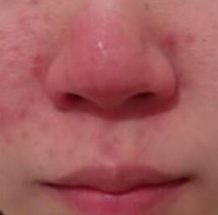 酒糟鼻的发病特点简介