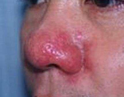 酒糟鼻的症状表现和成因