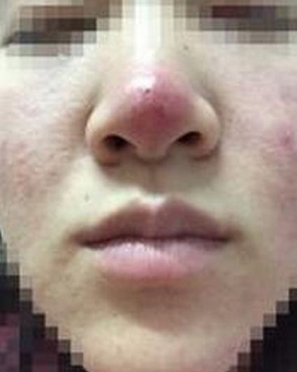 得酒糟鼻能治愈吗