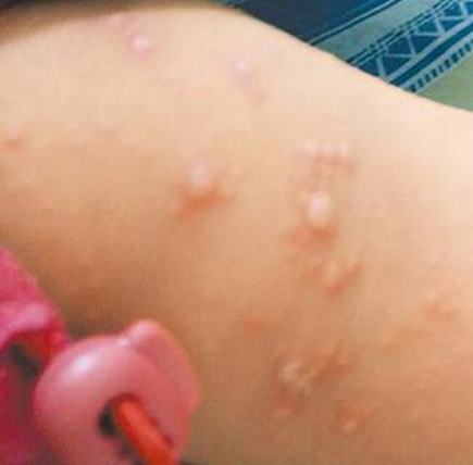 儿童口角疱疹原因是什么