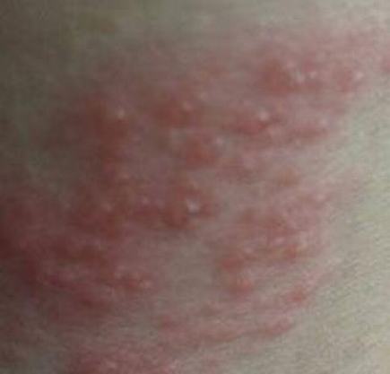 简述单纯疱疹病毒能怀孕吗