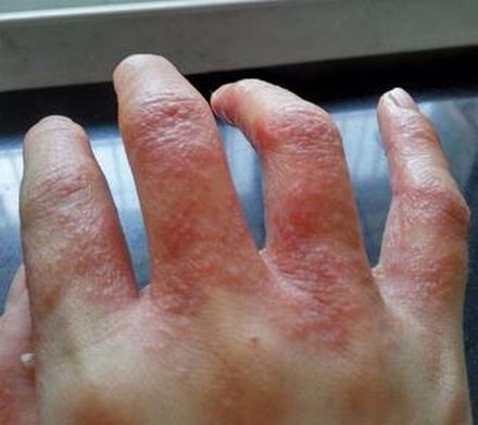 男性疱疹患者会出现哪些症状