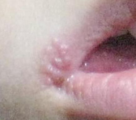 引发单纯疱疹的有哪些因素