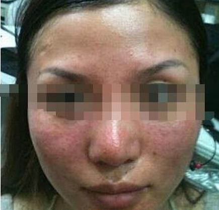 皮肤过敏的危害你都了解吗