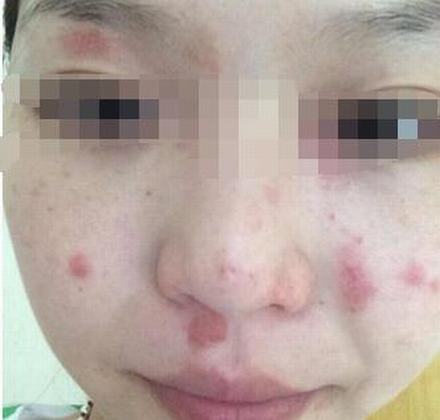 皮肤过敏对人体造成的伤害有什么