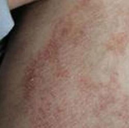 皮肤过敏患者要补充什么