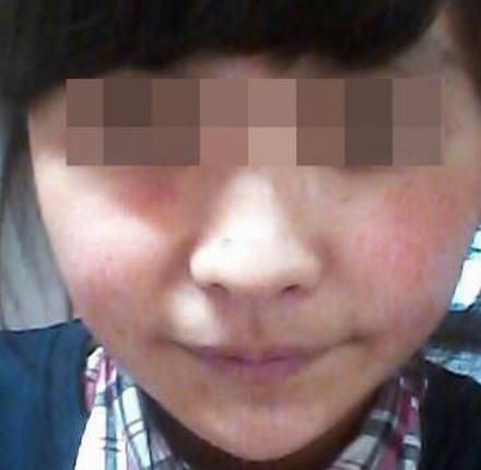 皮肤过敏了会自己好吗