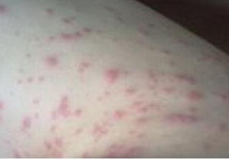 皮肤过敏荨麻疹