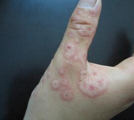 皮肤过敏荨麻疹是什么情况