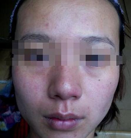 皮肤过敏要怎么处理