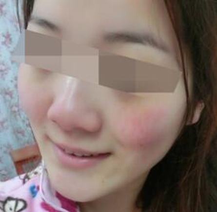 皮肤因此过敏的病因有什么
