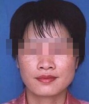 雀斑的伤害有什么