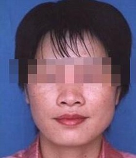 雀斑病人饮食的需要加以注意措施