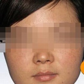 雀斑有什么危害