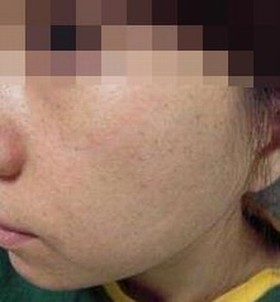 雀斑是哪些原因导致的