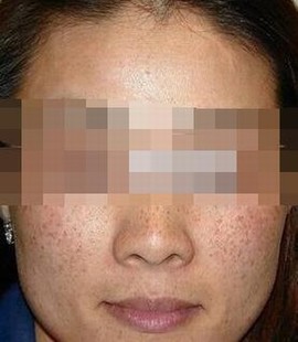 雀斑病人要小心什么