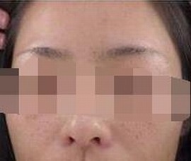 雀斑怎么除掉最有效