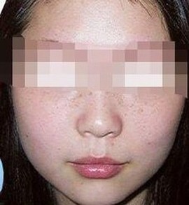 雀斑应怎么鉴别诊断
