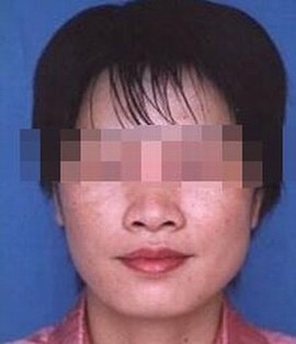 雀斑常见病因