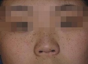雀斑的治疗大概需要多少钱