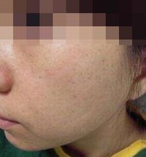 雀斑的四大典型特征是哪些