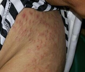 以下措施让湿疹宝宝永无后顾之忧
