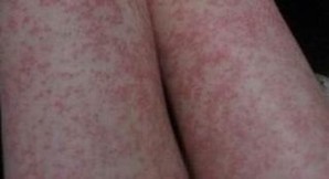 造成湿疹发病的主要有哪些原因