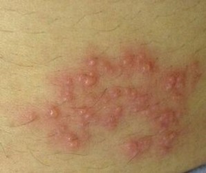 夏天要预防湿疹应该如何办呢