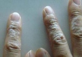 外阴湿疹预防措施的介绍