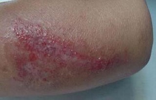怎样护理湿疹的出现