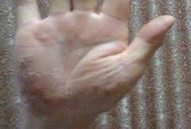外阴湿疹是什么原因